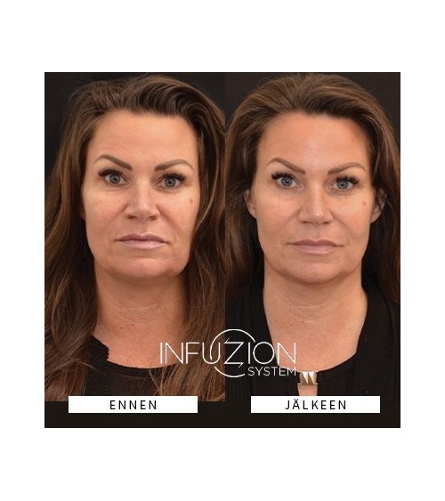 INFUZION System Skin Boozter laitekasvohoito