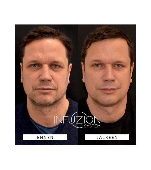 INFUZION Volymizer laitekasvohoito