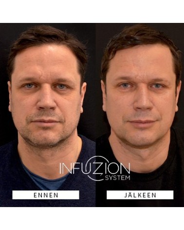 INFUZION Volymizer laitekasvohoito