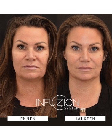 INFUZION Volymizer laitekasvohoito